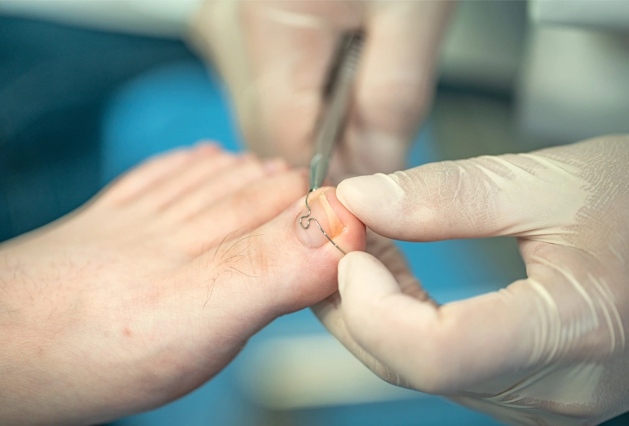 Nagelkorrekturspange Podologie Fußmed